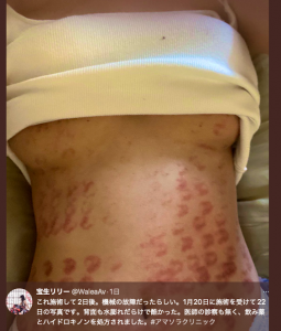 除毛搞得一身伤!宝生リリー(宝生莉莉)恐生涯终结!【EV棋牌】-EV棋牌