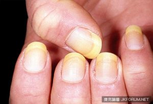 從指甲的狀態看出你的健康狀況,來看看你中了幾項!【EV棋牌】-EV棋牌